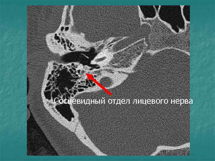 Сосцевидный отдел лицевого нерва 