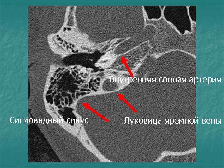 Внутренняя сонная артерия Сигмовидный синус Луковица яремной вены 