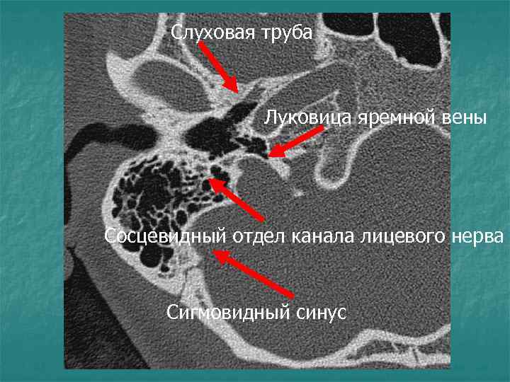 Слуховая труба Луковица яремной вены Сосцевидный отдел канала лицевого нерва Сигмовидный синус 