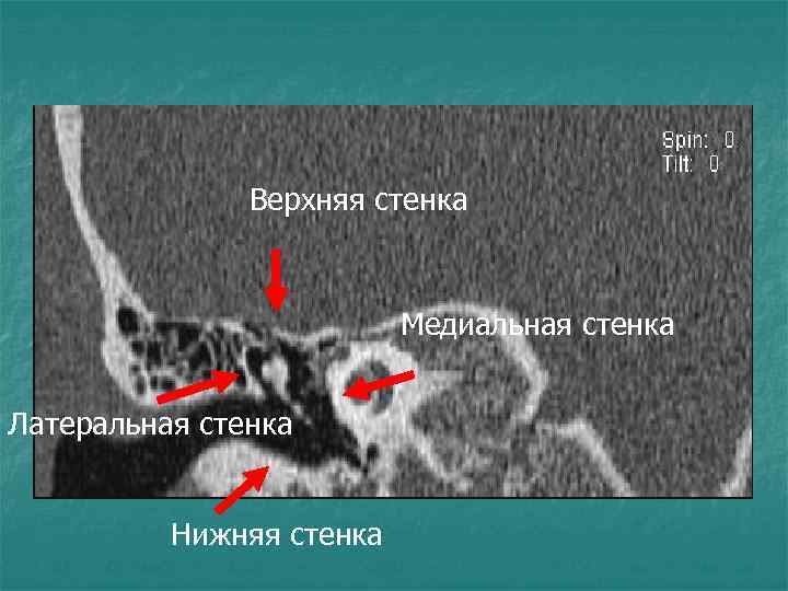 Верхняя стенка Медиальная стенка Латеральная стенка Нижняя стенка 