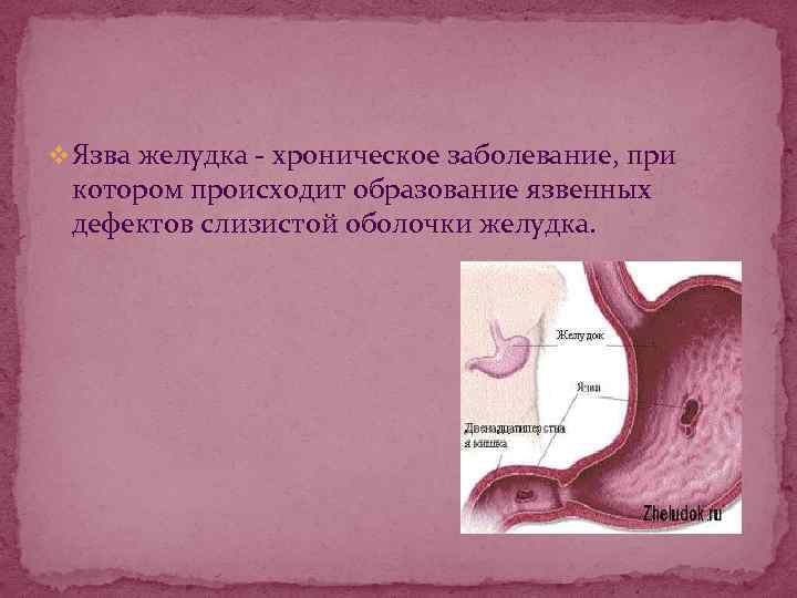 v Язва желудка - хроническое заболевание, при котором происходит образование язвенных дефектов слизистой оболочки