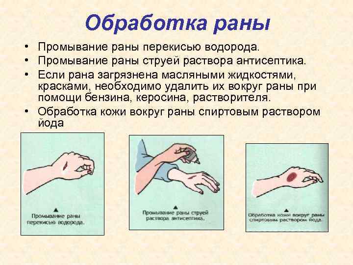 Обработка раны • Промывание раны перекисью водорода. • Промывание раны струей раствора антисептика. •