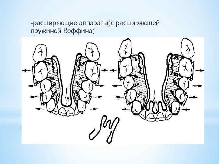 Пружина коффина. Пружина Коффина ортодонтия. Аппарат Курляндского ортодонтия. Расширяющая пластинка Коффина. Аппарат с пружиной Коффина