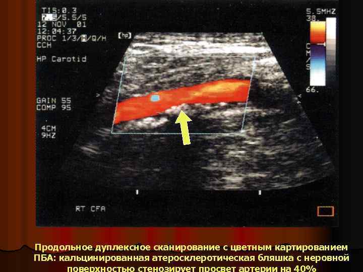 Продольное дуплексное сканирование с цветным картированием ПБА: кальцинированная атеросклеротическая бляшка с неровной поверхностью стенозирует