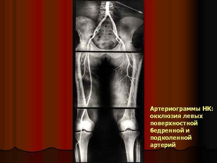 Артериограммы НК: окклюзия левых поверхностной бедренной и подколенной артерий 