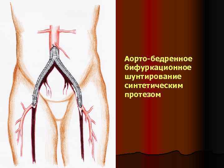 Аорто-бедренное бифуркационное шунтирование синтетическим протезом 