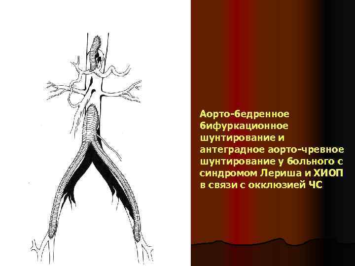 Аорто-бедренное бифуркационное шунтирование и антеградное аорто-чревное шунтирование у больного с синдромом Лериша и ХИОП