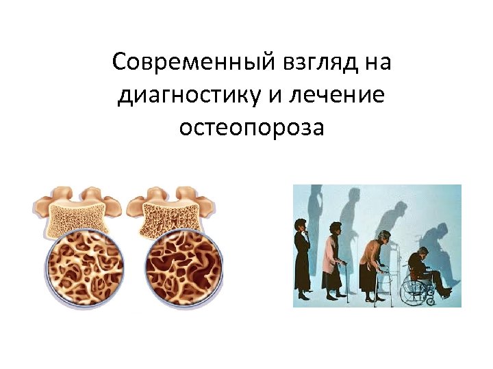 Современный взгляд на диагностику и лечение остеопороза 