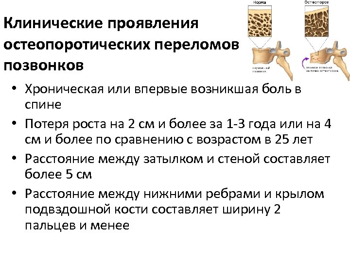 Клинические проявления остеопоротических переломов позвонков • Хроническая или впервые возникшая боль в спине •