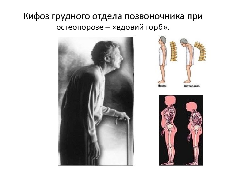 Кифоз грудного отдела позвоночника при остеопорозе – «вдовий горб» . 