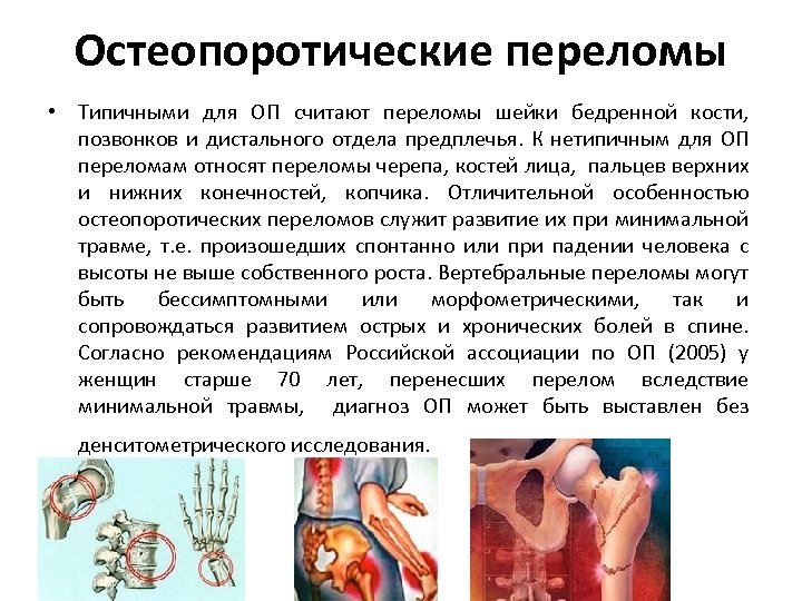 Остеопоротические переломы • Типичными для ОП считают переломы шейки бедренной кости, позвонков и дистального