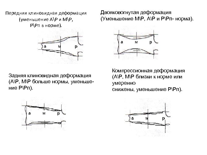 Передняя клиновидная деформация (уменьшение АР и МР, РРn в норме). Задняя клиновидная деформация (АР,