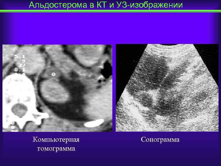 Альдостерома в КТ и УЗ-изображении Компьютерная томограмма Сонограмма 