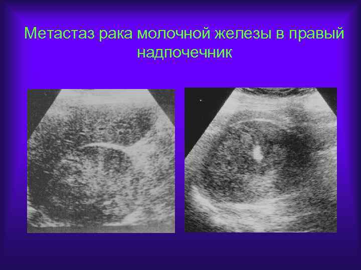 Рак молочной железы метастазы в легких. Метастазы в молочной железе. Метастазы опухоли молочной железы. Метастазы м молочной железы. Метастазы молочной железы в лимфоузлах.