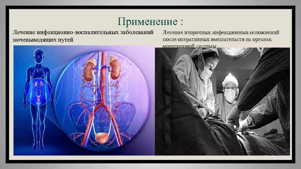 Применение лечение. Инфекционно-воспалительные заболевания мочеполовой системы\. Инфекционно-воспалительных заболеваний мочевыделительной системы. Воспалительные заболевания органов мочеполовой системы. Осложнения заболеваний мочеполовой системы.