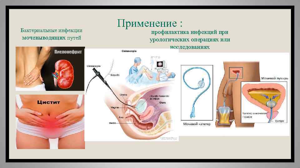 Бактериальные инфекции мочевыводящих путей Применение : профилактика инфекций при урологических операциях или исследованиях 