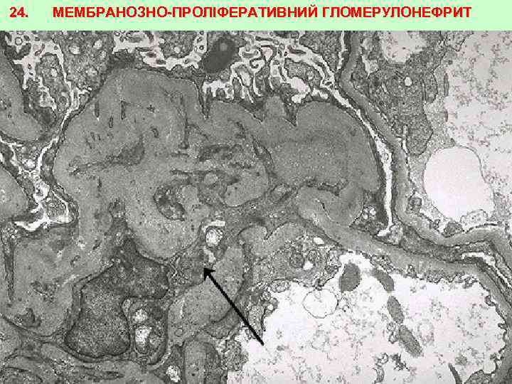 24. МЕМБРАНОЗНО-ПРОЛІФЕРАТИВНИЙ ГЛОМЕРУЛОНЕФРИТ 