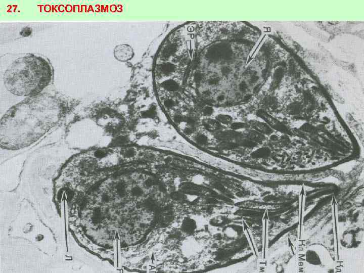 27. ТОКСОПЛАЗМОЗ 