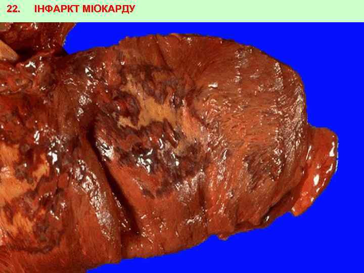 22. ІНФАРКТ МІОКАРДУ 