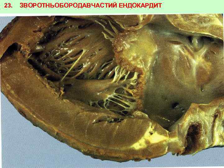 23. ЗВОРОТНЬОБОРОДАВЧАСТИЙ ЕНДОКАРДИТ 