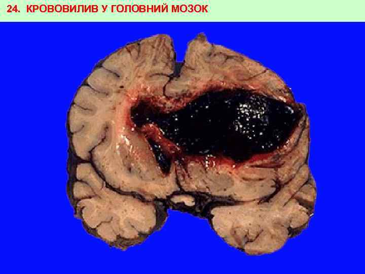 24. КРОВОВИЛИВ У ГОЛОВНИЙ МОЗОК 