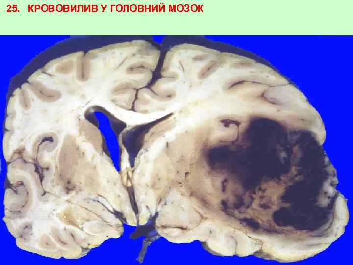 25. КРОВОВИЛИВ У ГОЛОВНИЙ МОЗОК 