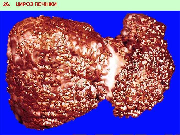 26. ЦИРОЗ ПЕЧІНКИ 