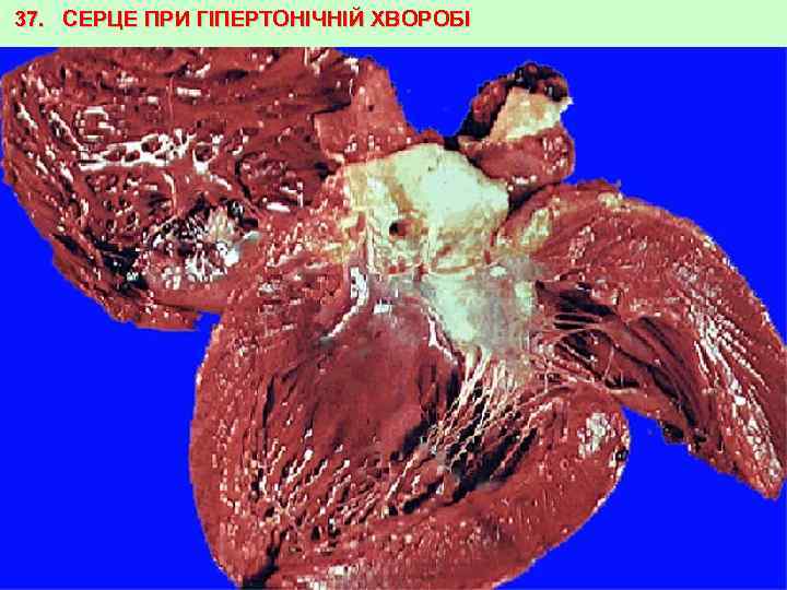 37. СЕРЦЕ ПРИ ГІПЕРТОНІЧНІЙ ХВОРОБІ 