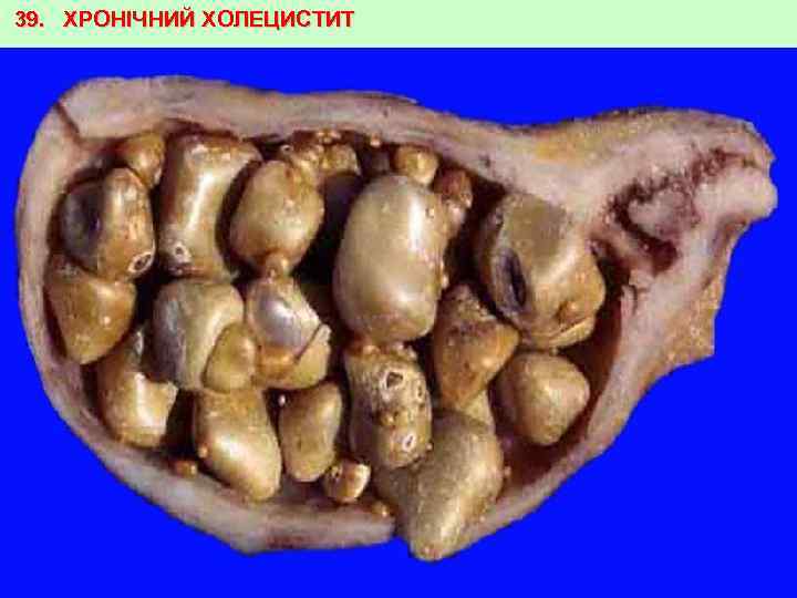 39. ХРОНІЧНИЙ ХОЛЕЦИСТИТ 