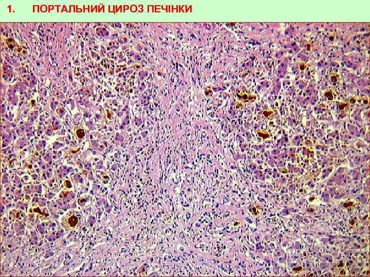 1. ПОРТАЛЬНИЙ ЦИРОЗ ПЕЧІНКИ 