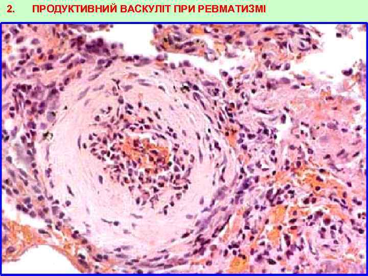 2. ПРОДУКТИВНИЙ ВАСКУЛІТ ПРИ РЕВМАТИЗМІ 