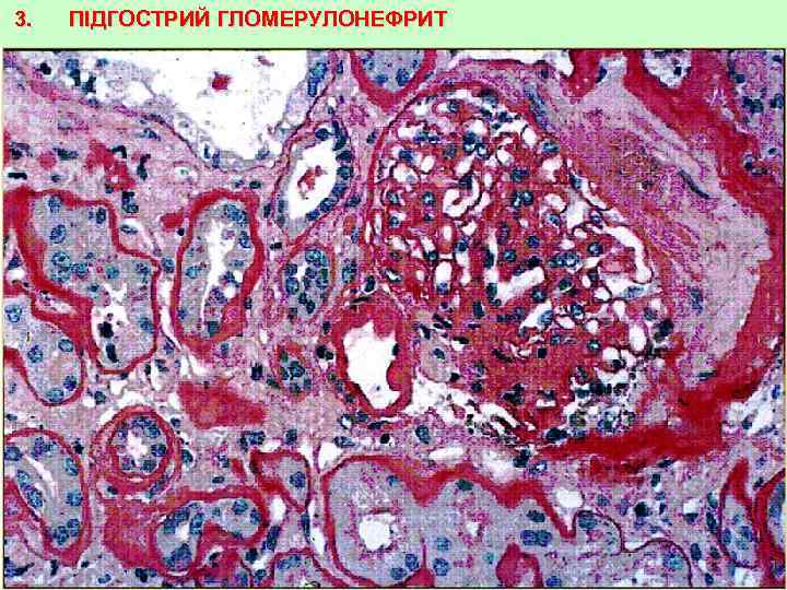 3. ПІДГОСТРИЙ ГЛОМЕРУЛОНЕФРИТ 