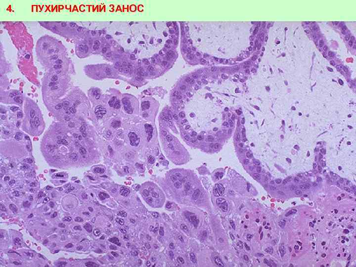 4. ПУХИРЧАСТИЙ ЗАНОС 