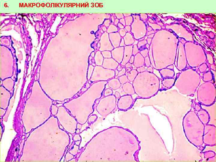 6. МАКРОФОЛІКУЛЯРНИЙ ЗОБ 