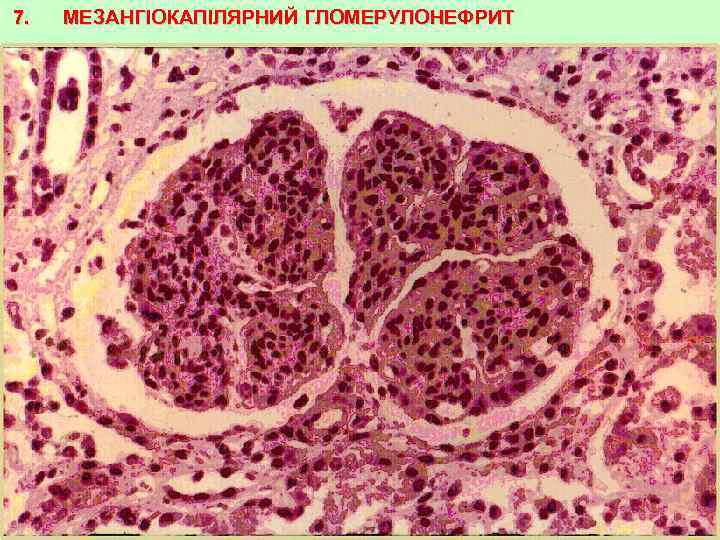 7. МЕЗАНГІОКАПІЛЯРНИЙ ГЛОМЕРУЛОНЕФРИТ 