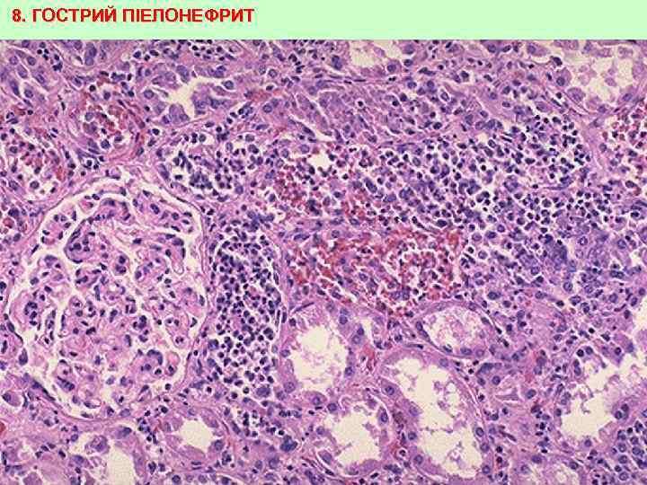 8. ГОСТРИЙ ПІЕЛОНЕФРИТ 