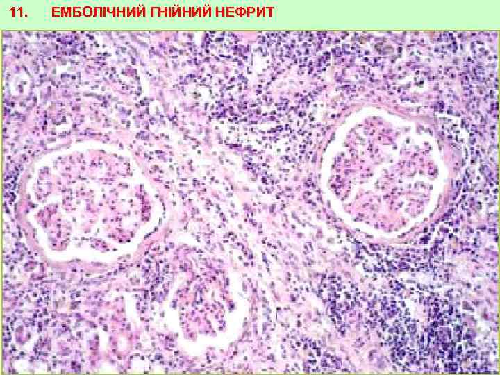 11. ЕМБОЛІЧНИЙ ГНІЙНИЙ НЕФРИТ 