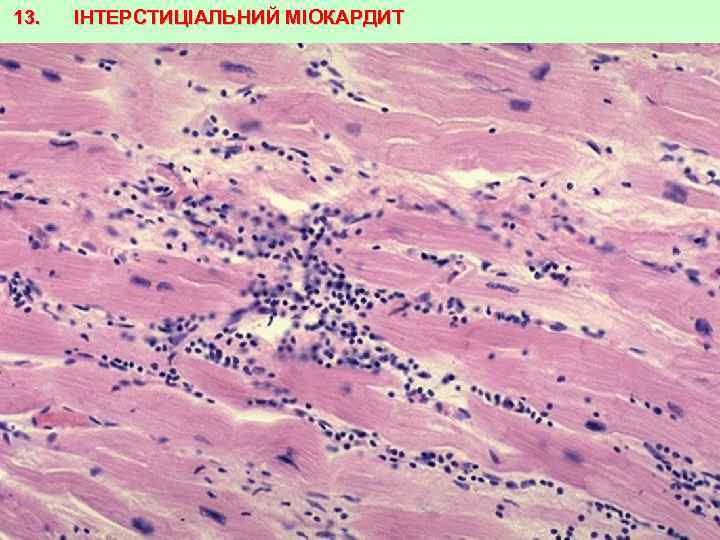 13. ІНТЕРСТИЦІАЛЬНИЙ МІОКАРДИТ 