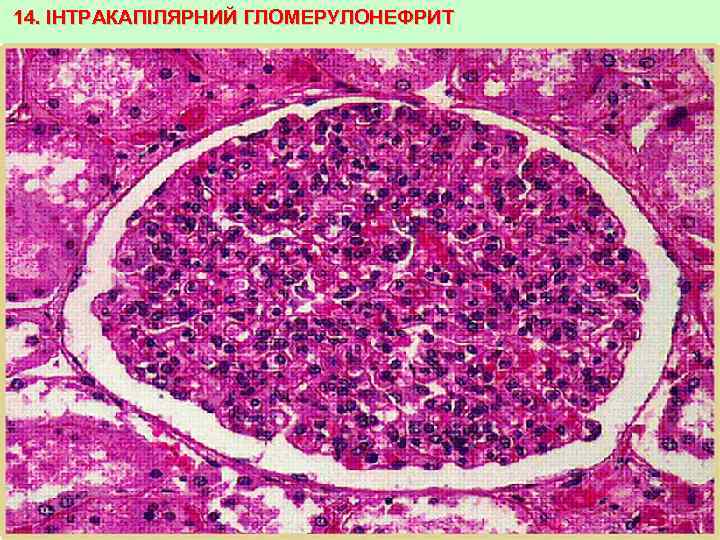 14. ІНТРАКАПІЛЯРНИЙ ГЛОМЕРУЛОНЕФРИТ 