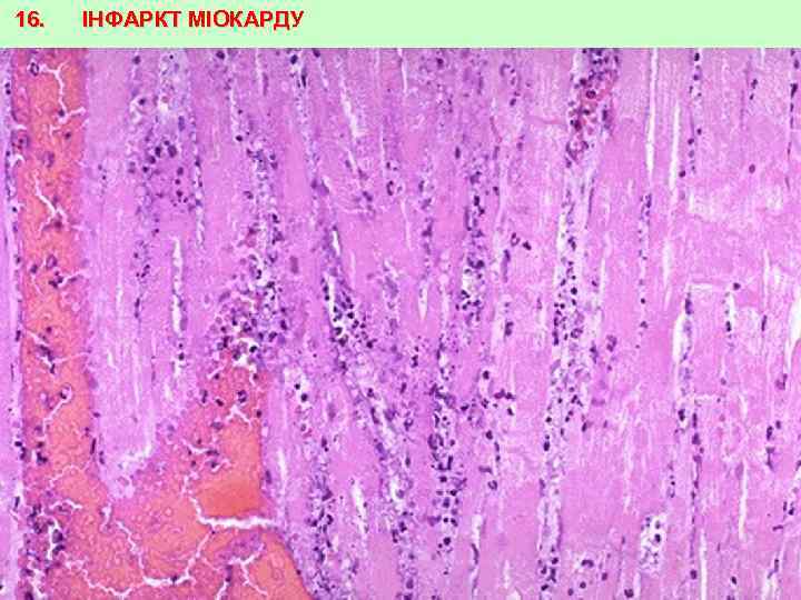 16. ІНФАРКТ МІОКАРДУ 