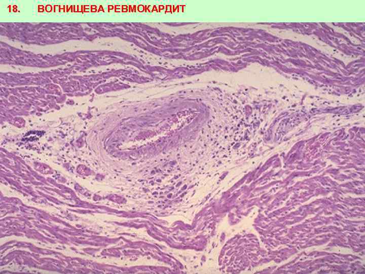 18. ВОГНИЩЕВА РЕВМОКАРДИТ 