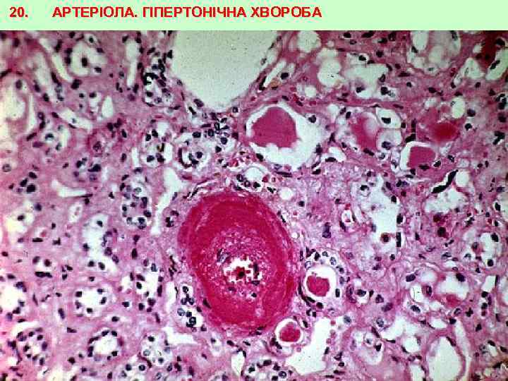 20. АРТЕРІОЛА. ГІПЕРТОНІЧНА ХВОРОБА 