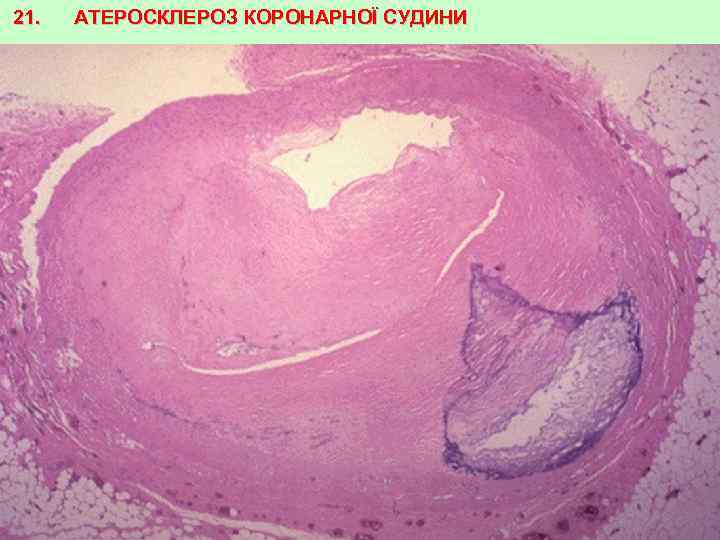 21. АТЕРОСКЛЕРОЗ КОРОНАРНОЇ СУДИНИ 