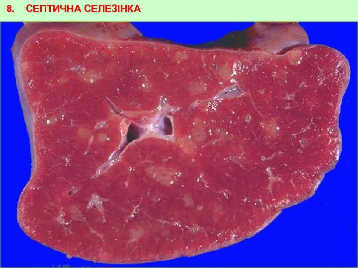 8. СЕПТИЧНА СЕЛЕЗІНКА 