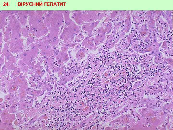 24. ВІРУСНИЙ ГЕПАТИТ 