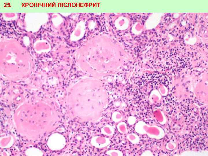 25. ХРОНІЧНИЙ ПІЄЛОНЕФРИТ 