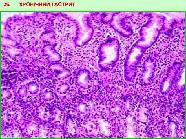 26. ХРОНІЧНИЙ ГАСТРИТ 