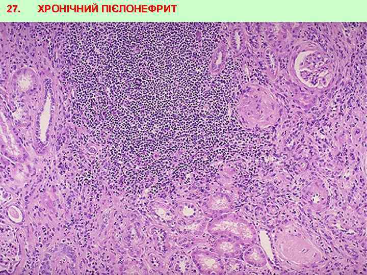 27. ХРОНІЧНИЙ ПІЄЛОНЕФРИТ 