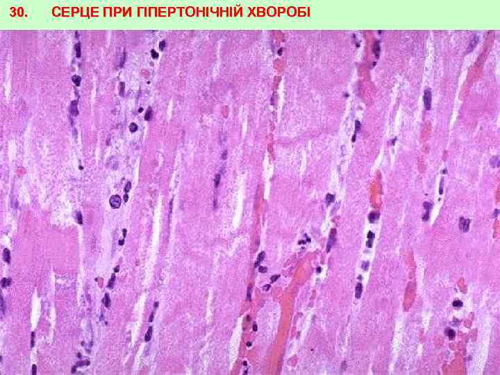 30. СЕРЦЕ ПРИ ГІПЕРТОНІЧНІЙ ХВОРОБІ 