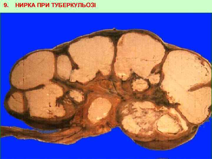 9. НИРКА ПРИ ТУБЕРКУЛЬОЗІ 